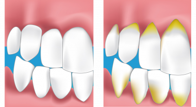 paradontie dentiste conflans